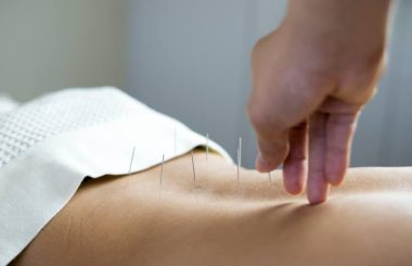 Acupuntura